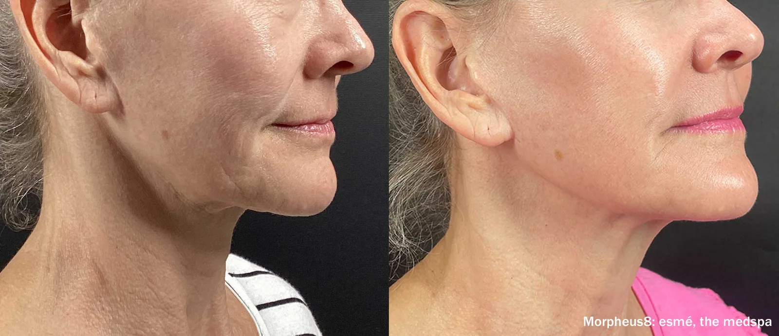 Morpheus8® RF Microneedling in Indianapolis
