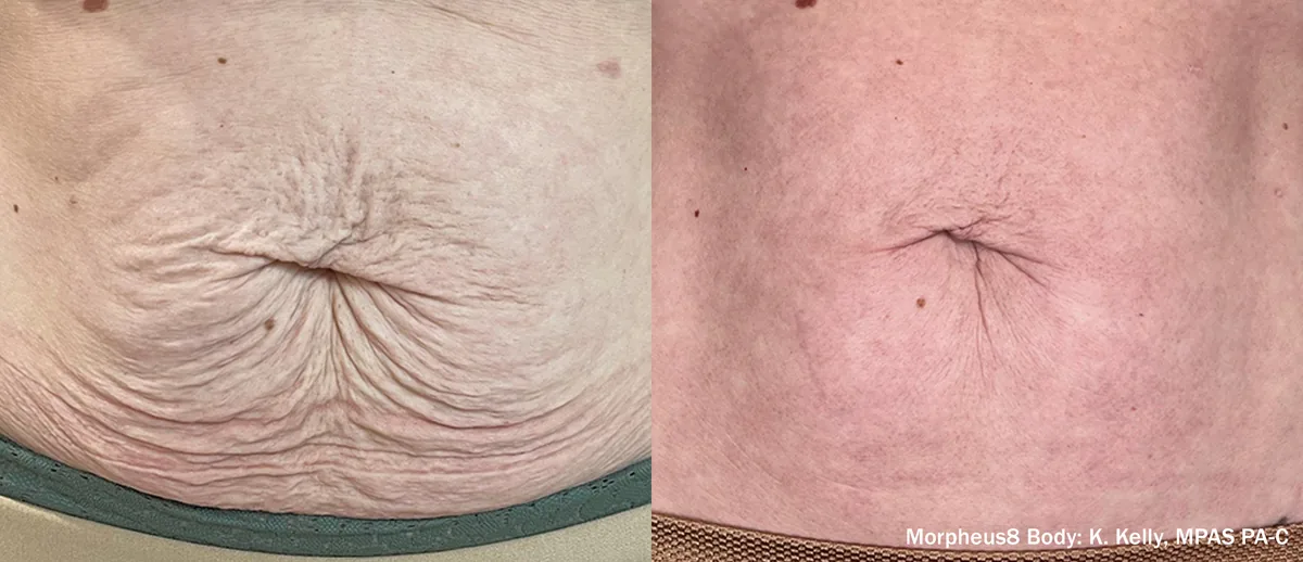 Morpheus8 before and after, Body Area (24 Weeks)