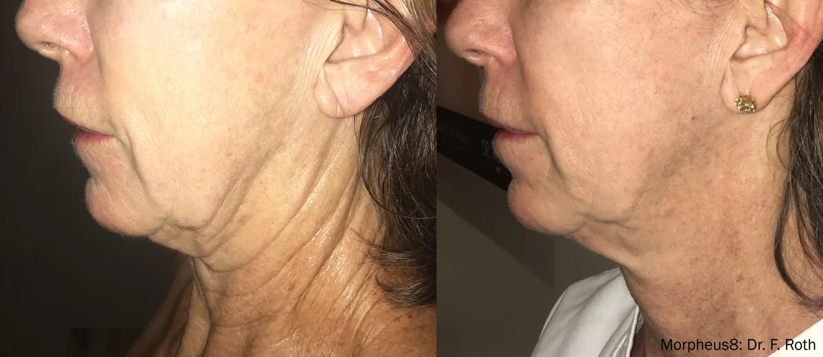 Morpheus8 before and after, facial skin tightening