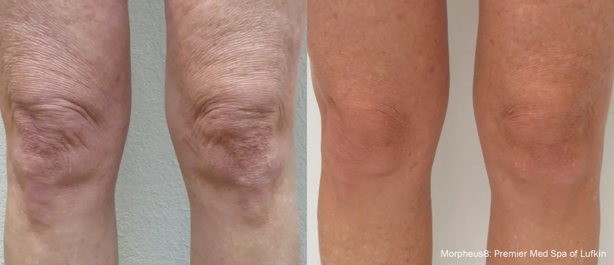 Morpheus8 before and after, Neck & Lower Face